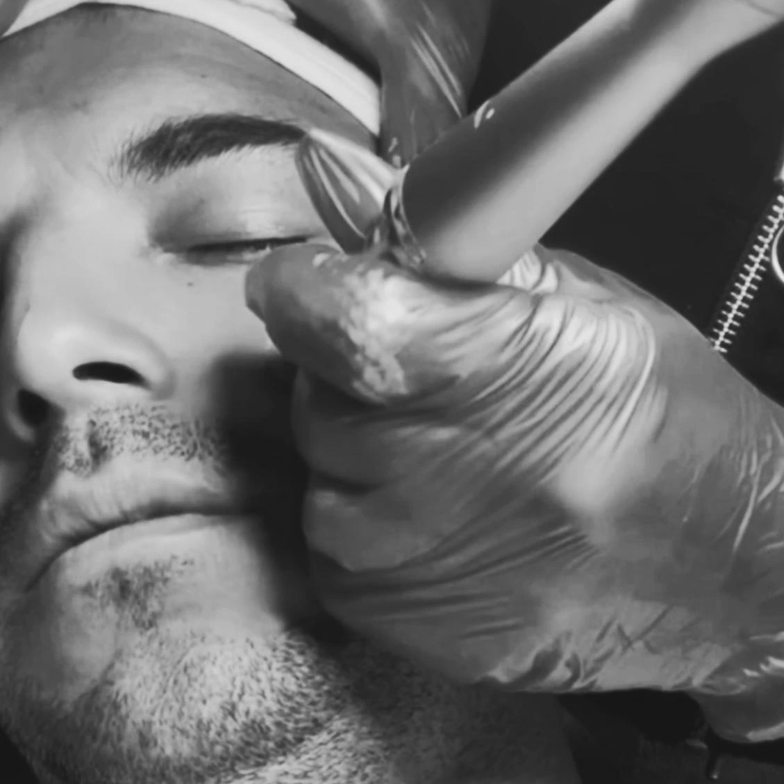 Dermapen (Microneedling)